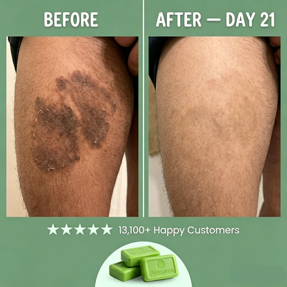 🦵Avasoma® Multi-Purpose Antifungal Bar: One Solution for Feet, Body & Persistent Itch