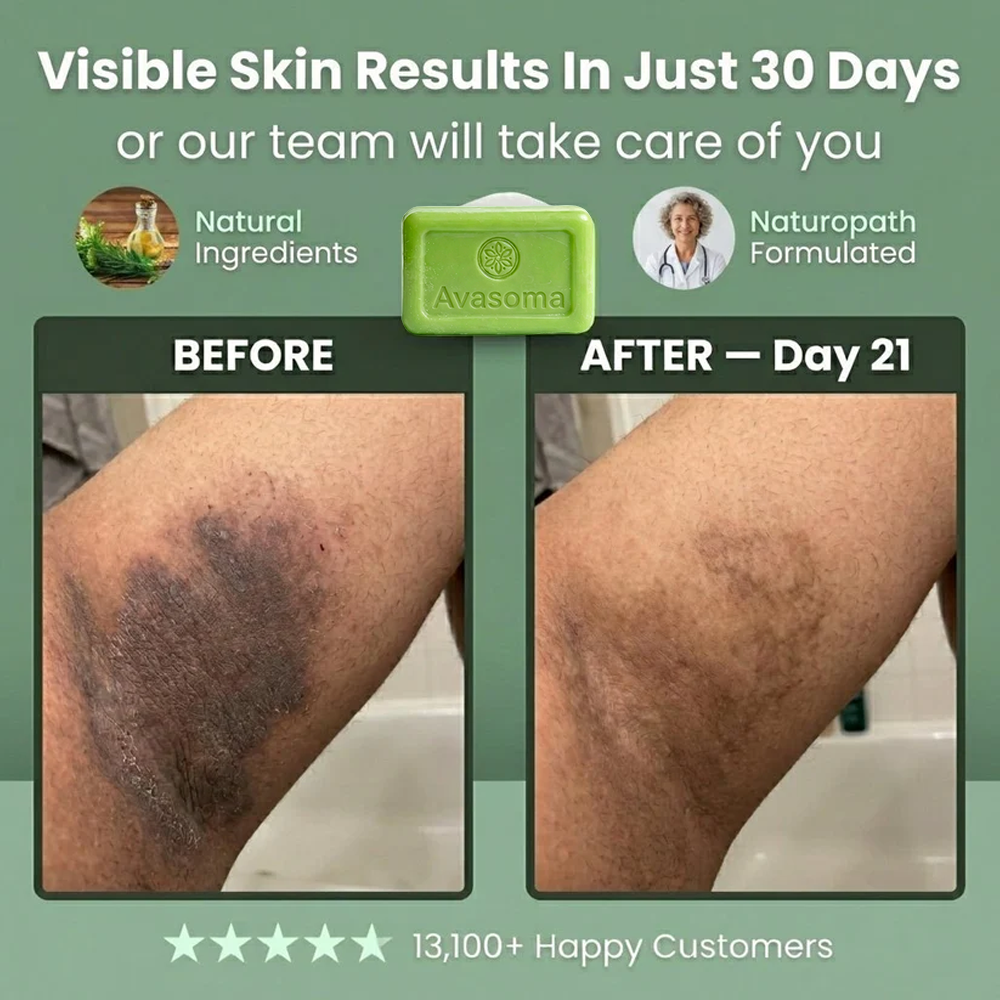 🦵Avasoma® Multi-Purpose Antifungal Bar: One Solution for Feet, Body & Persistent Itch