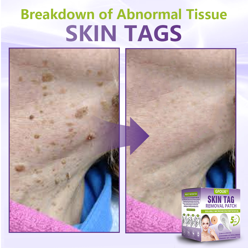 GFOUK® Soluble Microneedle Botanical Skin Tag Removal Patch