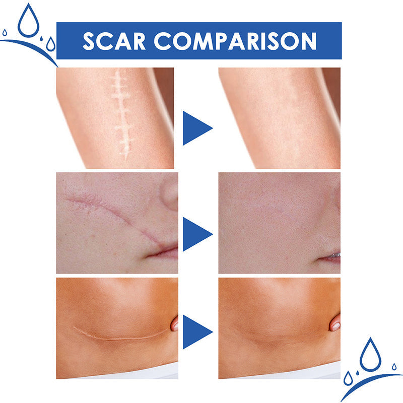 Avasoma® Scar Repair Cream for Men and Women, fade scars and tighten skin in one step